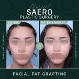نتائج حقن الدهون للوجه في SAERO Plastic Surgery، زيادة واضحة في الامتلاء