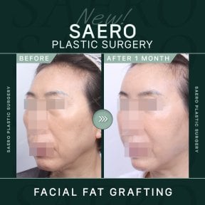 نتائج حقن الدهون في الوجه في SAERO Plastic Surgery، تحسن واضح في حجم الوجه