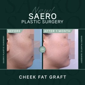 نتائج حقن دهون الخد في SAERO Plastic Surgery، امتلاء الخدود بعد شهر واحد