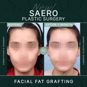 نتائج حقن الدهون في الوجه قبل وبعد في SAERO Plastic Surgery بعد شهر من الإجراء