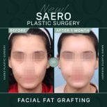 نتائج حقن الدهون في الوجه قبل وبعد في SAERO Plastic Surgery بعد شهر من الإجراء
