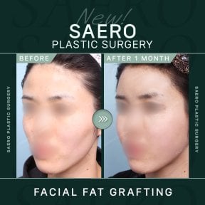 نتائج حقن الدهون في الوجه في SAERO Plastic Surgery، امتلاء الخدين بعد شهر واحد