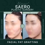 نتائج حقن الدهون في الوجه في SAERO Plastic Surgery، امتلاء الخدين بعد شهر واحد