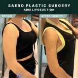 نتائج شفط دهون الذراع قبل وبعد في SAERO Plastic Surgery – ذراع أنحف