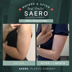نتائج شفط دهون الذراع قبل وبعد في SAERO Plastic Surgery – ذراع أنحف