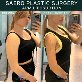 نتائج شفط دهون الذراع قبل وبعد في SAERO Plastic Surgery، ذراعان أنحف خلال شهر