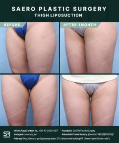 نتائج شفط دهون الفخذين قبل وبعد في SAERO Plastic Surgery، مظهر أفخاذ أنحف