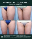 نتائج شفط دهون الفخذين قبل وبعد في SAERO Plastic Surgery، مظهر أفخاذ أنحف