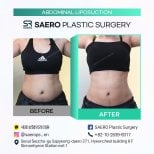 نتائج شفط دهون البطن قبل وبعد في SAERO Plastic Surgery، خصر أنحف