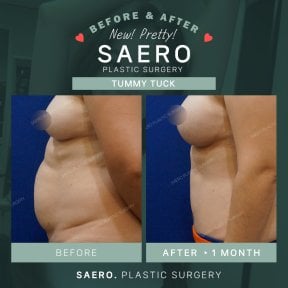 نتائج شد البطن قبل وبعد في SAERO Plastic Surgery – بطن مسطح بعد شهر واحد