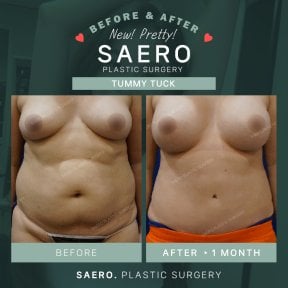 نتائج شد البطن قبل وبعد في SAERO Plastic Surgery – بطن مسطح بعد شهر واحد