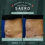 نتائج شد البطن قبل وبعد في SAERO Plastic Surgery – بطن أكثر نعومة وشدًا