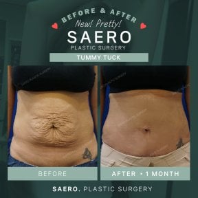 نتائج شد البطن قبل وبعد في SAERO Plastic Surgery – بطن أكثر نعومة واستواء