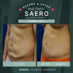 نتائج شد البطن قبل وبعد في SAERO Plastic Surgery – بطن أكثر تماسكًا واستواءً