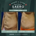 نتائج شد البطن قبل وبعد في SAERO Plastic Surgery – بطن أكثر تماسكًا واستواءً
