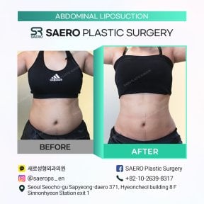 نتائج شفط دهون البطن قبل وبعد في SAERO Plastic Surgery، خصر أنحف