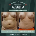 نتائج شد البطن قبل وبعد في SAERO Plastic Surgery – بطن مسطح بعد شهر واحد