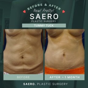 نتائج شد البطن قبل وبعد في SAERO Plastic Surgery – بطن أكثر تماسكًا واستواءً
