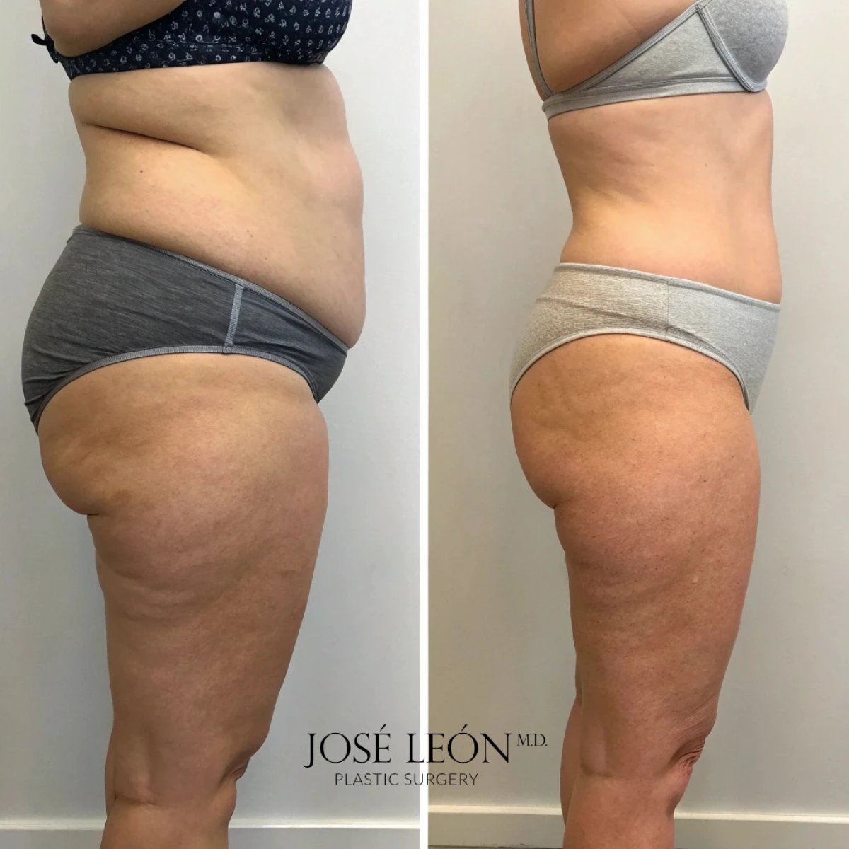 Antes y después de liposucción en 3 áreas en clínica José León, resultado visible