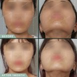 قبل وبعد تصغير عظم الوجنة في SAERO Plastic Surgery – نتائج تحديد الوجه واضحة