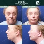 نتائج شد الوجه قبل وبعد في SAERO Plastic Surgery، تجديد واضح للوجه بعد أسبوعين