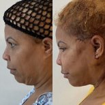 Результати до і після deep plane facelift – покращення лінії підборіддя та шиї