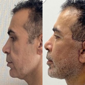 Результати до і після deep plane facelift у чоловіка – помітне омолодження обличчя