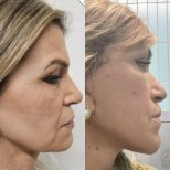 Результати до і після deep plane facelift – омолодження та покращення контуру обличчя
