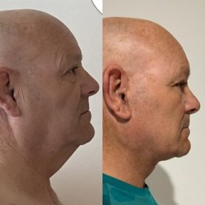 Результати до і після deep plane facelift – покращення контуру щелепи та шиї у чоловіка