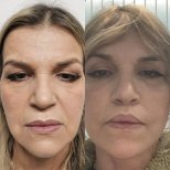 Результати до і після deep plane facelift – омолодження обличчя та гладка шкіра