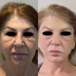 Результати до і після deep plane facelift – омолодження обличчя та гладка шкіра