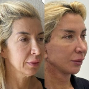 Результати до і після Deep Plane Facelift, омолодження обличчя та чіткіший контур
