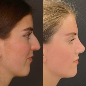 before-after photo rhinoplasty-nose-job