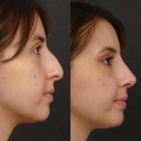 before-after photo rhinoplasty-nose-job
