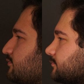 before-after photo rhinoplasty-nose-job