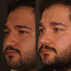 before-after photo rhinoplasty-nose-job