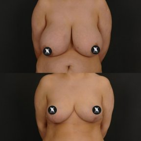before-after photo mastopexy-breast-lift-contour-plastics
