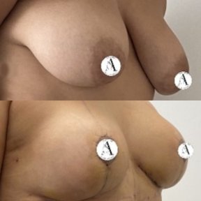 before-after photo mastopexy-breast-lift-contour-plastics