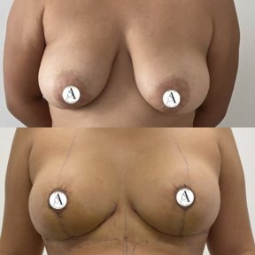 before-after photo mastopexy-breast-lift-contour-plastics