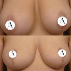before-after photo mastopexy-breast-lift-contour-plastics