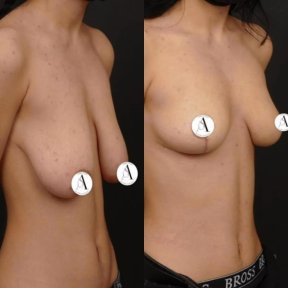 before-after photo mastopexy-breast-lift-contour-plastics