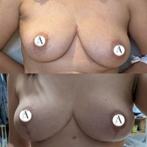 before-after photo mastopexy-breast-lift-contour-plastics