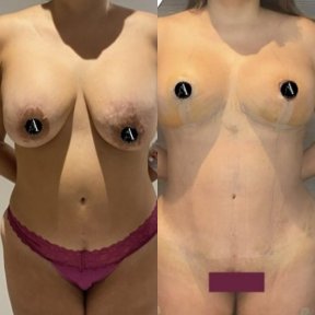before-after photo breast-implants-with-breast-lift