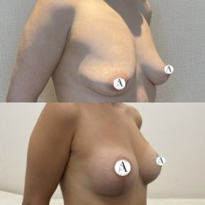 before-after photo breast-implants-with-breast-lift