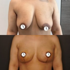 before-after photo breast-implants-with-breast-lift