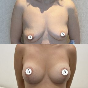 before-after photo breast-implants-with-breast-lift