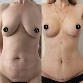 Mommy makeover before and after results – breast lift and tummy tuck visible improvement