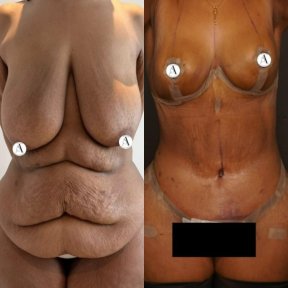 Mommy makeover before and after results – improved breast and abdominal contour