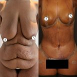 Mommy makeover before and after results – improved breast and abdominal contour