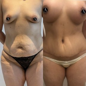 Before and after mommy makeover results – improved abdomen and breast contour